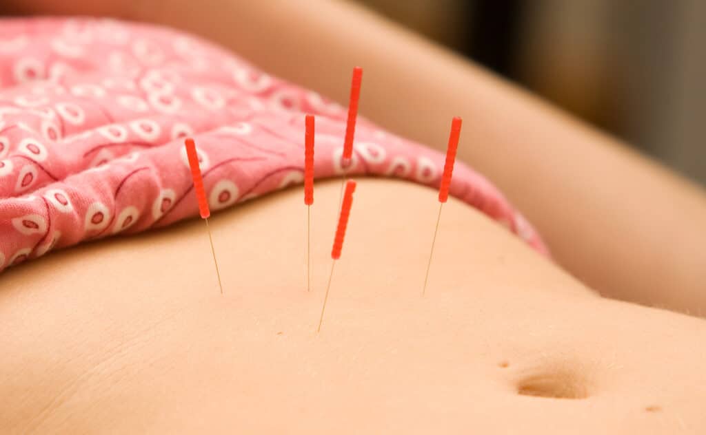 Acupuncture