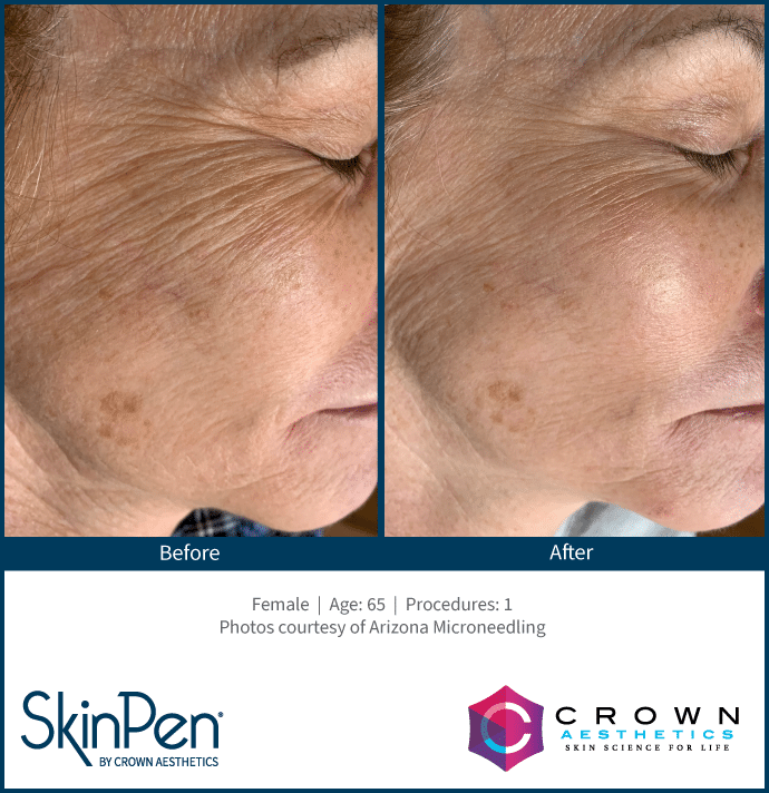 SkinPen OPTIMAL